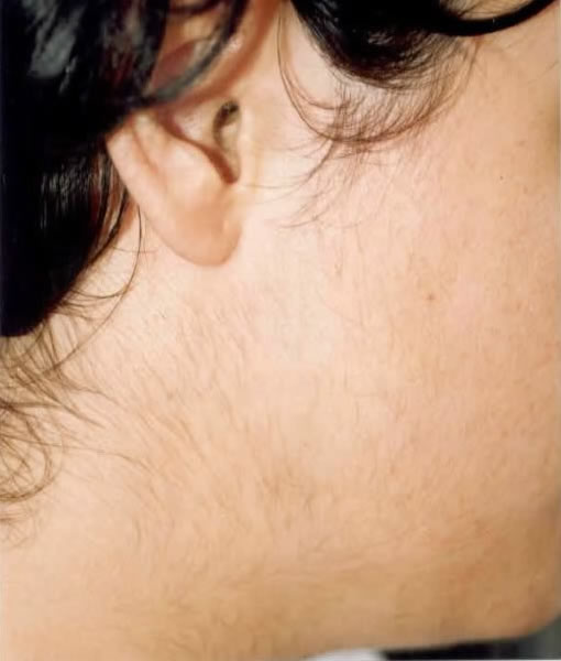 electrolysis after long island great neck